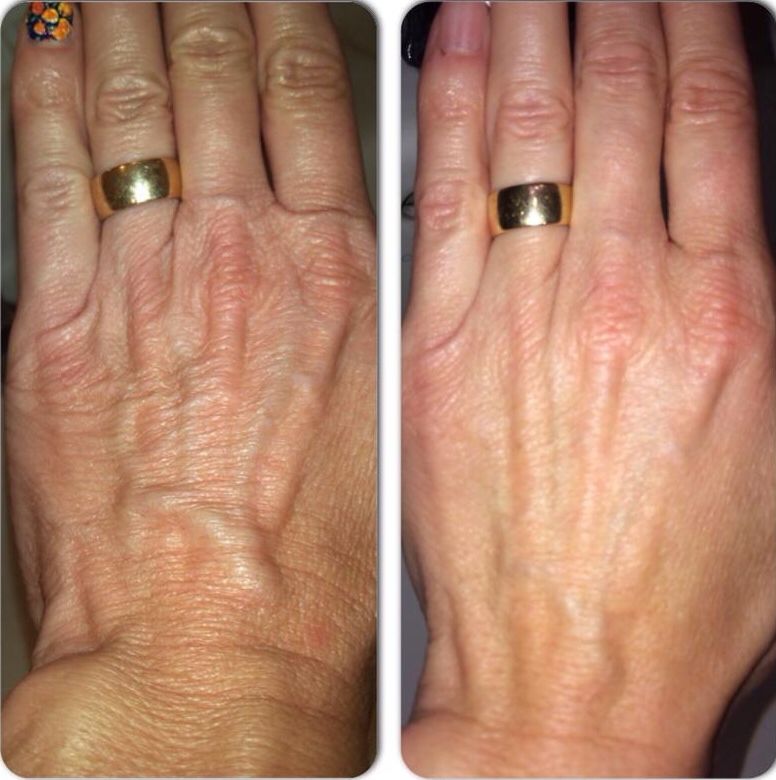 Before and after HandSolace results, Eileen, 66 · Melbourne